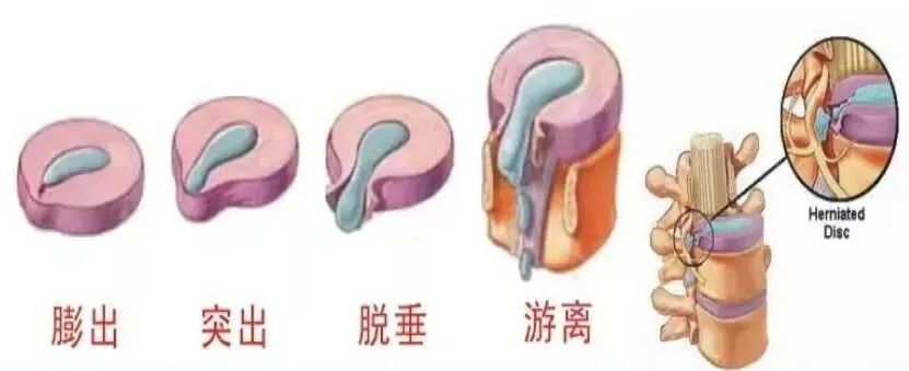 c臂机怎么上升治疗腰突症，用C臂机+超声，实现取长补短、一针两用_https://www.jmylbn.com_新闻资讯_第3张