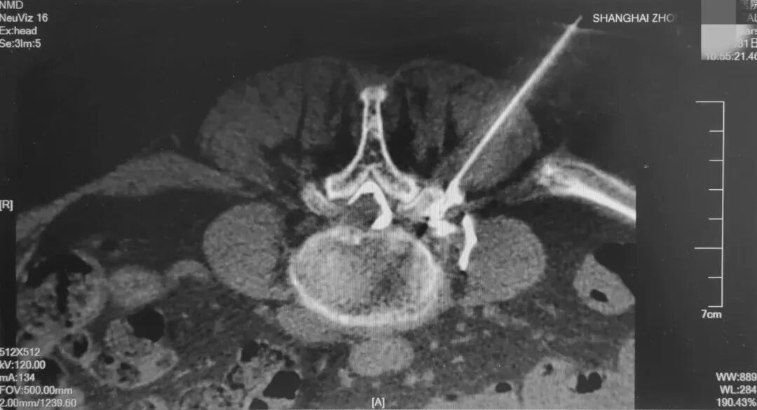 c臂机怎么上升治疗腰突症，用C臂机+超声，实现取长补短、一针两用_https://www.jmylbn.com_新闻资讯_第6张