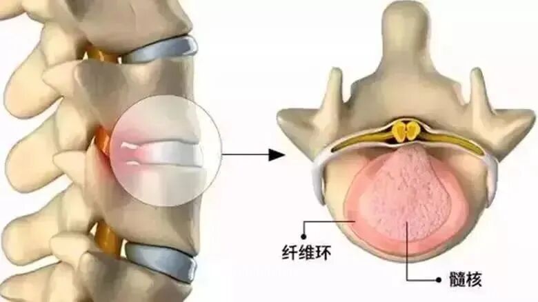 c臂机怎么上升治疗腰突症，用C臂机+超声，实现取长补短、一针两用_https://www.jmylbn.com_新闻资讯_第2张