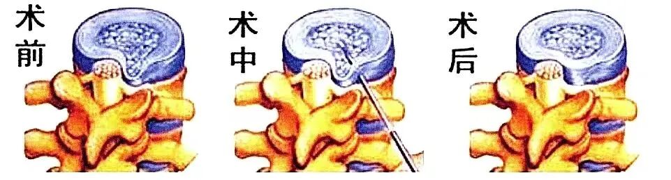 c臂机怎么上升治疗腰突症，用C臂机+超声，实现取长补短、一针两用_https://www.jmylbn.com_新闻资讯_第4张