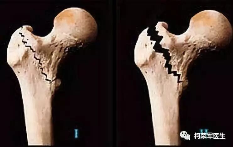 老年骨质疏松症常见骨折及治疗方式