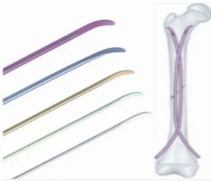 钛针是什么材料儿童骨折不用慌，小小钛针来帮忙！_https://www.jmylbn.com_新闻资讯_第2张