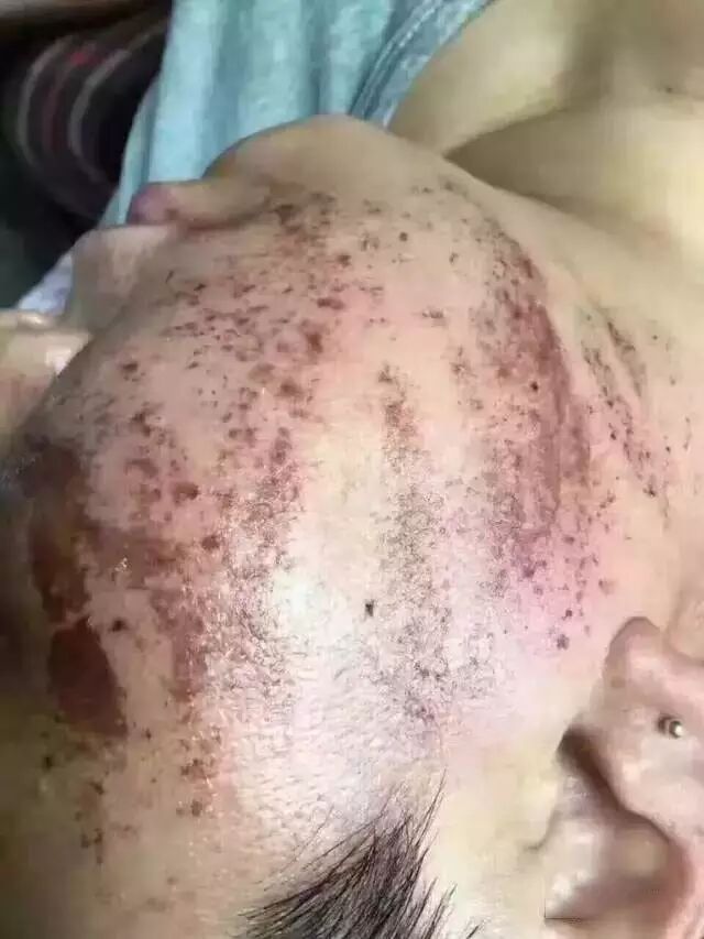 50元一支的"水光针"致银川一女士面瘫花580做的眉毛.