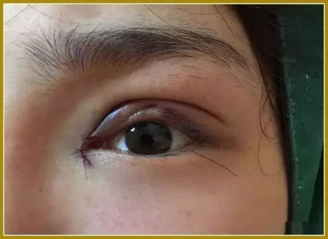 双眼皮手术为什么会失败?