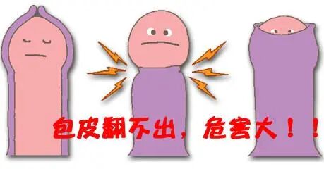 包皮吻合器是什么更快、更无痛、更微创的包皮环切术----吻合器包皮环切术甘霖有专家哦_https://www.jmylbn.com_新闻资讯_第2张