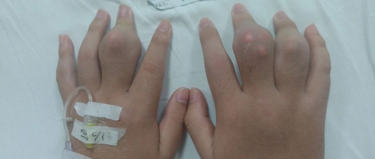 一天一杯奶茶，00后男生手脚关节上长满了“钻石”……这个病年轻化明显！