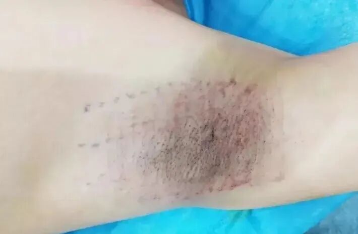 夏天过去，腋臭的味道就没有了吗？