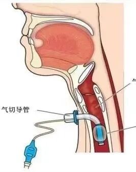 患者怎么选择人工鼻患者行气管切开术后的护理_https://www.jmylbn.com_新闻资讯_第14张