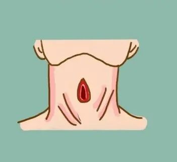 患者怎么选择人工鼻患者行气管切开术后的护理_https://www.jmylbn.com_新闻资讯_第19张