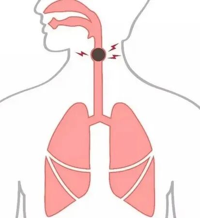 患者怎么选择人工鼻患者行气管切开术后的护理_https://www.jmylbn.com_新闻资讯_第3张