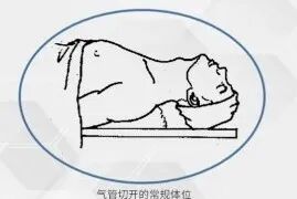 患者怎么选择人工鼻患者行气管切开术后的护理_https://www.jmylbn.com_新闻资讯_第11张