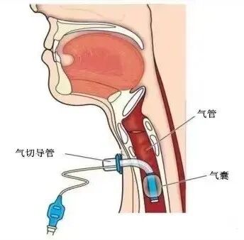 患者怎么选择人工鼻患者行气管切开术后的护理_https://www.jmylbn.com_新闻资讯_第6张