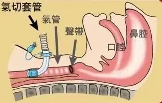 患者怎么选择人工鼻患者行气管切开术后的护理_https://www.jmylbn.com_新闻资讯_第1张