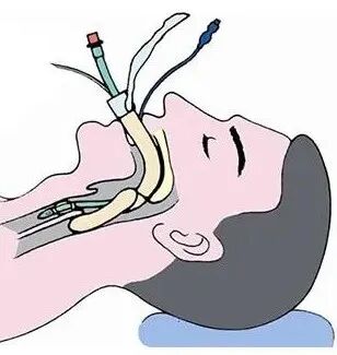 患者怎么选择人工鼻患者行气管切开术后的护理_https://www.jmylbn.com_新闻资讯_第13张