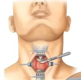 患者怎么选择人工鼻患者行气管切开术后的护理_https://www.jmylbn.com_新闻资讯_第5张
