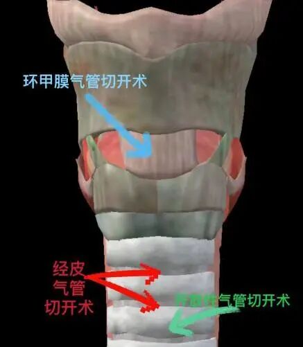 患者怎么选择人工鼻患者行气管切开术后的护理_https://www.jmylbn.com_新闻资讯_第7张