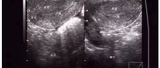 子宫内膜回声不均是怎么回事？