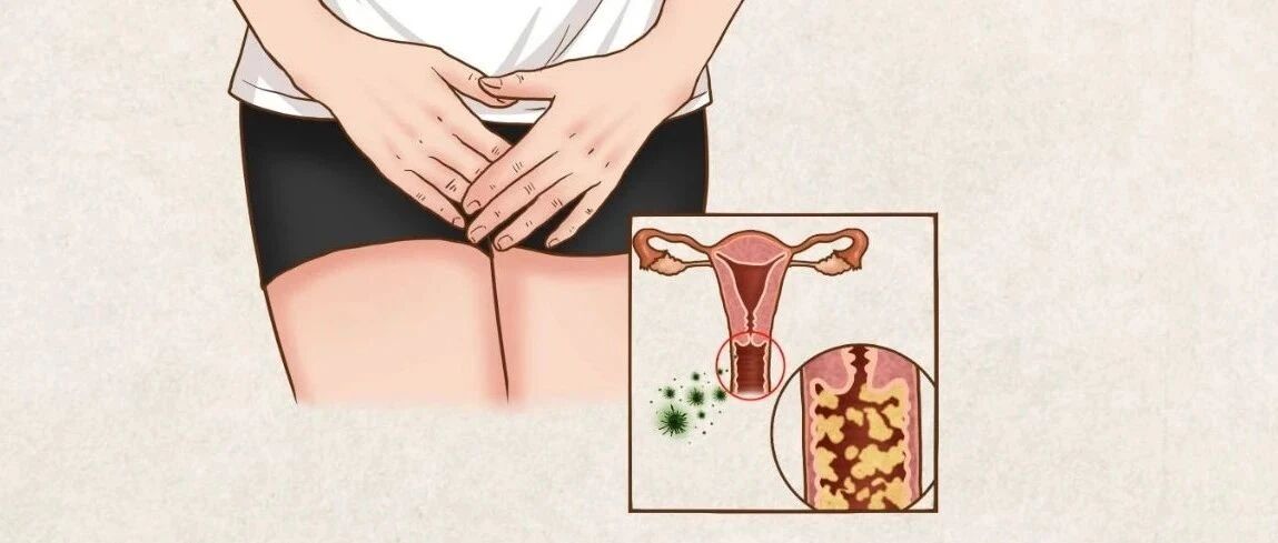 阴道没有绝对“清洁”，贵在自律！