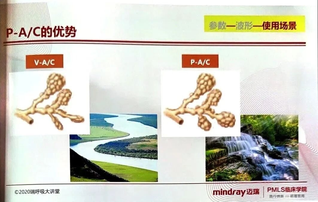 呼吸机pip是什么意思3压力控制辅助通气 P-A／C模式_https://www.jmylbn.com_新闻资讯_第10张