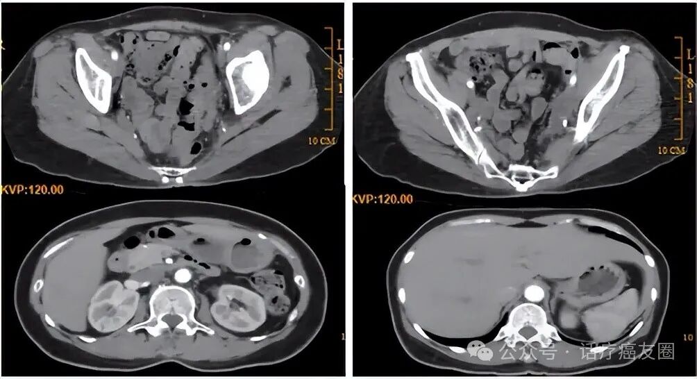 得了癌症还能活几年？术后做好5件事，或能多活几十年！