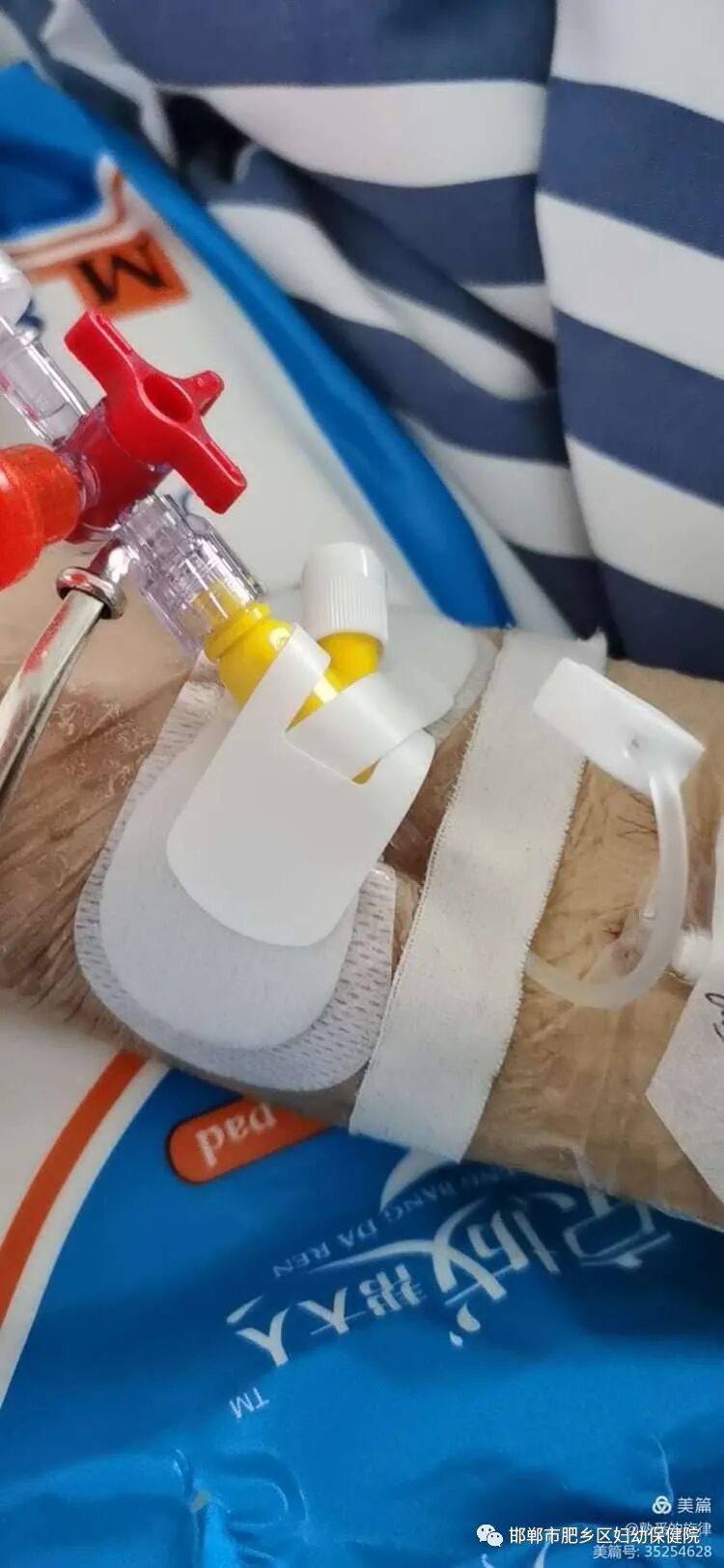 bd留置针怎么使用留置针穿刺操作方法及注意事项_https://www.jmylbn.com_新闻资讯_第10张