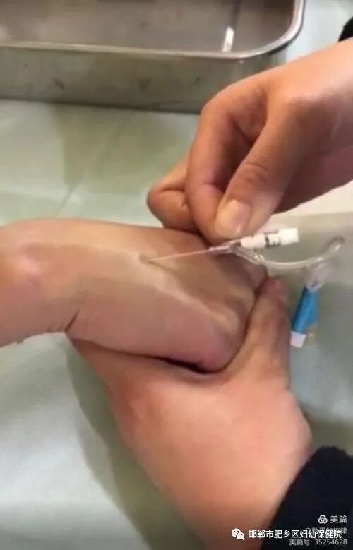 bd留置针怎么使用留置针穿刺操作方法及注意事项_https://www.jmylbn.com_新闻资讯_第8张