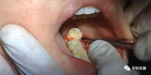 必转！拔牙前隐瞒病史后果真的自负不起！