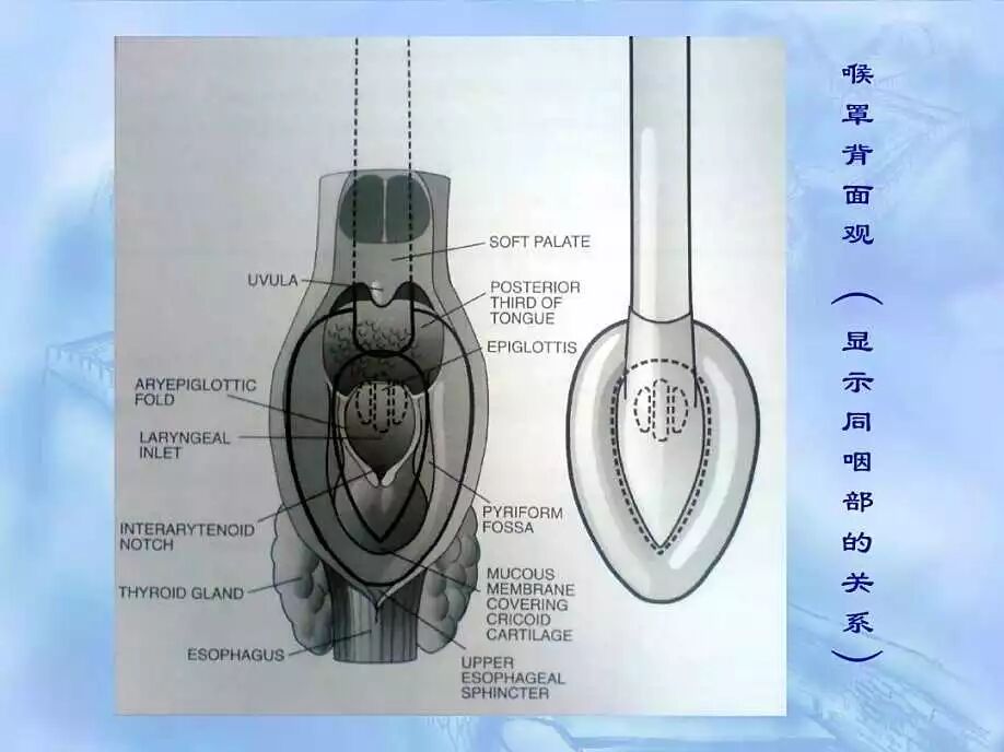 为什么要用喉罩应用喉罩通气期间易发生的并发症处理_https://www.jmylbn.com_新闻资讯_第3张