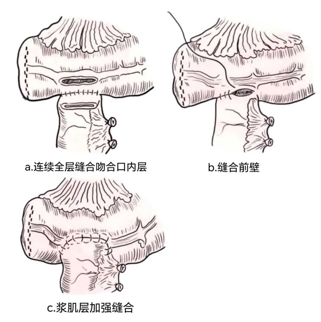 端端吻合器是什么消化道吻合技巧_https://www.jmylbn.com_新闻资讯_第22张