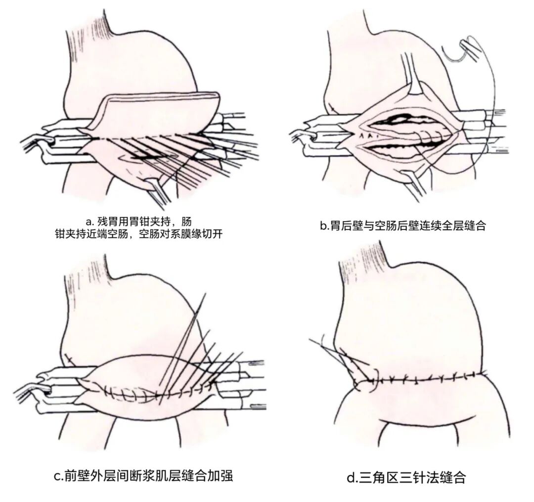 端端吻合器是什么消化道吻合技巧_https://www.jmylbn.com_新闻资讯_第2张