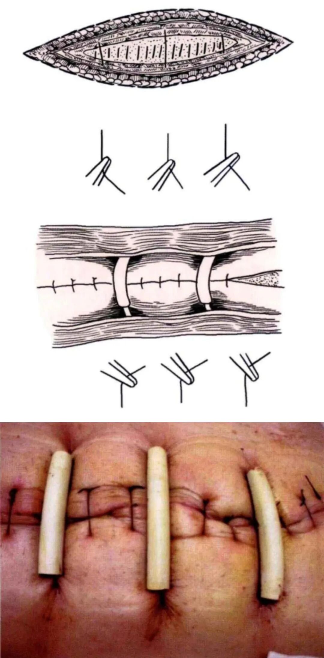 小儿的PDS怎么缝的缝合要点 ｜ 单纯对合缝合_https://www.jmylbn.com_新闻资讯_第26张