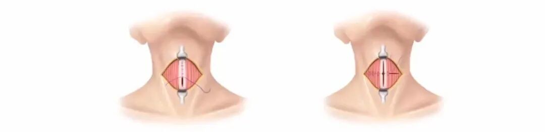 倒刺线怎么缝合甲状腺手术缝合技术和缝合材料选择_https://www.jmylbn.com_新闻资讯_第6张