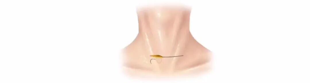 倒刺线怎么缝合甲状腺手术缝合技术和缝合材料选择_https://www.jmylbn.com_新闻资讯_第12张