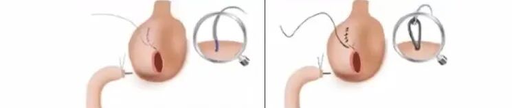 直肠吻合器钉子什么样结直肠手术缝合技术和缝线选择_https://www.jmylbn.com_新闻资讯_第25张