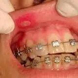 口腔颊面管怎么放置牙套兄，请你不要再磨我嘴了！_https://www.jmylbn.com_新闻资讯_第1张