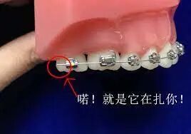 口腔颊面管怎么放置牙套兄，请你不要再磨我嘴了！_https://www.jmylbn.com_新闻资讯_第5张