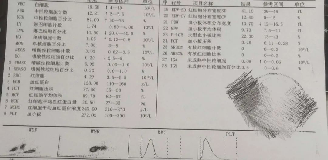 粒细胞百分比81.00%偏高，淋巴细胞百分比11.50%偏低，单核细胞计数1.0510^9/l。