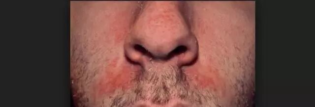 脂溢性皮炎皮肤