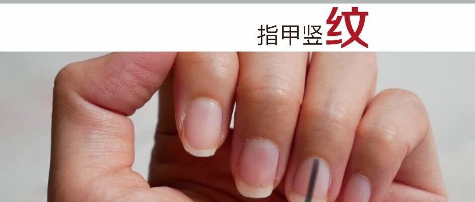 指甲有竖纹，怎么回事？
