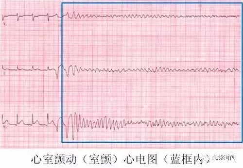心电监护怎么看图【PLUS版】心电图危急值识别及紧急处理，值得每个医生收藏！！！_https://www.jmylbn.com_新闻资讯_第26张