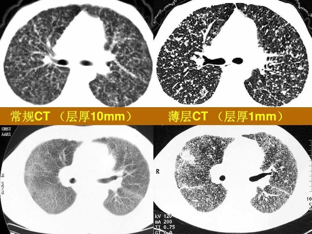 什么情况用呼吸机使用无创呼吸机还是有创呼吸机，您会选择吗？_https://www.jmylbn.com_新闻资讯_第2张
