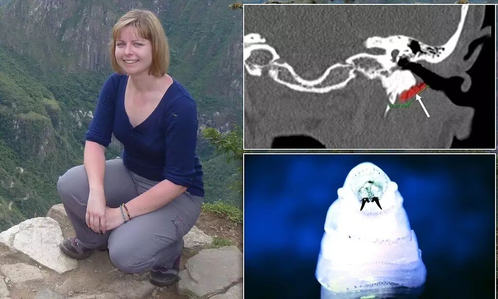 染上噬肉蛆的英国游客哈里斯(harris),右下角为新大陆螺旋蝇的幼虫