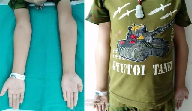 3d打印精准矫形肘内翻畸形