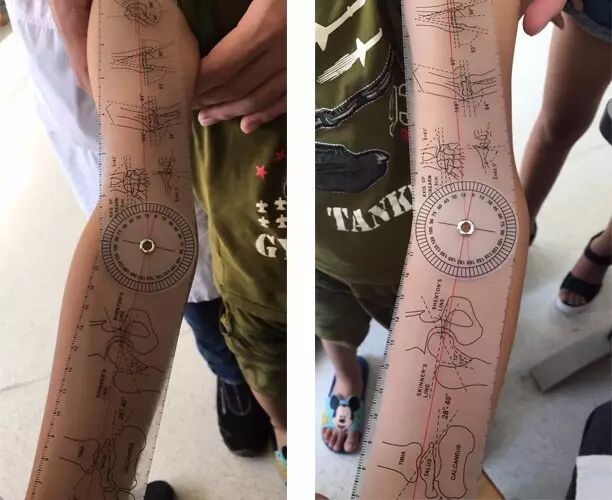 3d打印精准矫形肘内翻畸形