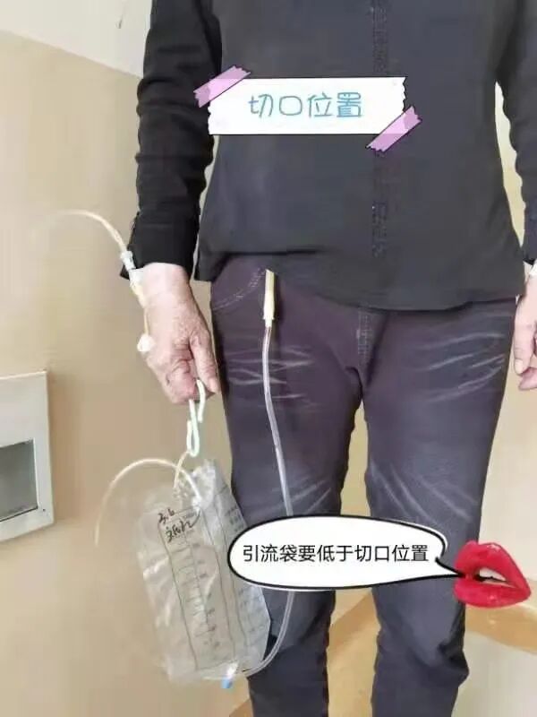 医用引流管什么样的【省立科普】福建省立医院护理专家教你如何家庭保“管”_https://www.jmylbn.com_新闻资讯_第5张