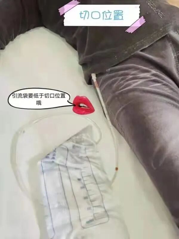 医用引流管什么样的【省立科普】福建省立医院护理专家教你如何家庭保“管”_https://www.jmylbn.com_新闻资讯_第4张