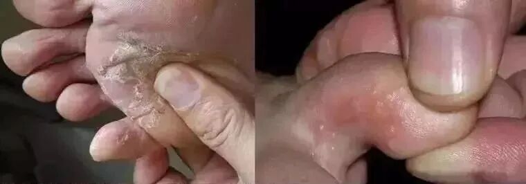 医用气垫圈怎么使用“气垫椰子鞋”火了！大半个娱乐圈都在穿，一脚踩进云朵里！全掌按摩，踩屎感爆棚，防滑耐磨易清洗，每走一步都是享受！_https://www.jmylbn.com_新闻资讯_第9张