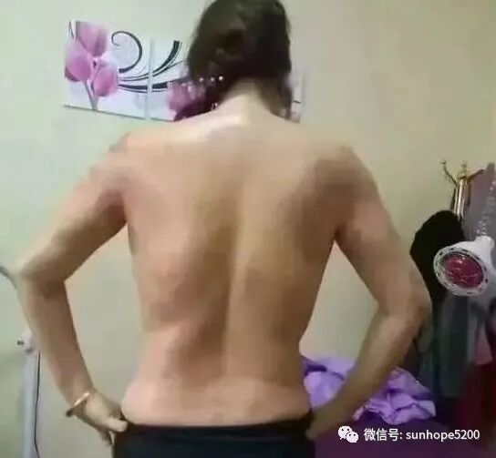 理疗仪怎么治头痛TBS理疗仪+精油开背后，免疫力提升了，不再怕感冒，失眠头痛，肠胃不适，长期便秘，经期疼痛，月经不调，肩颈酸痛....._https://www.jmylbn.com_新闻资讯_第6张