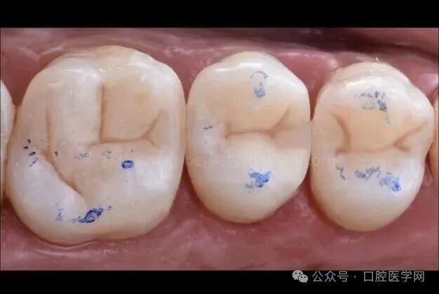 深龋：保守性单次就诊处理