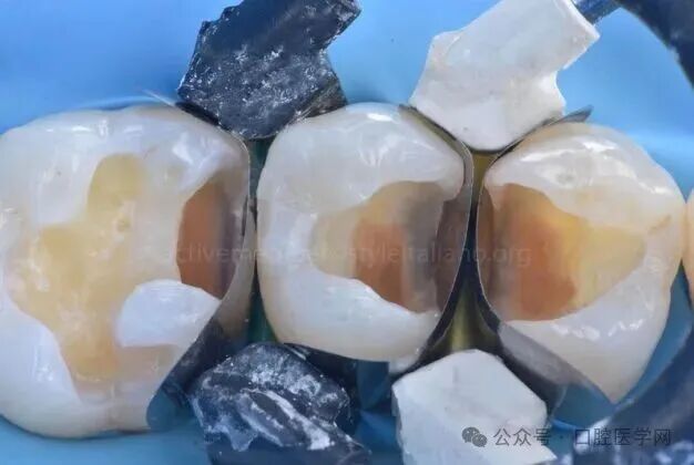 深龋：保守性单次就诊处理